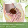 Deep Endometriosis or Recto-uterine Obliteration Without Endometrioma