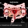 Time for reassessment : Laparoscopic surgery and bowel endometriosis