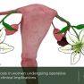 Fallopian tube endometriosis