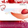 Is hemoglobin the immune trigger of endometriosis?