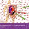 Combined contraceptive pills and immune system cells in the endometriotic cyst wall
