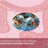 Which surgical technique is best for rectal endometriosis? 