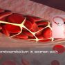 The association between severe endometriosis and venous thromboembolism