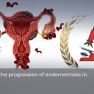 Antimicrobial agent ornidazole yields promising effects in an animal model of endometriosis