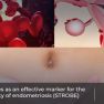 Do not underestimate the power of red blood cell evaluation in endometriosis