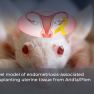 New Model Can Help Understand How Endometriosis-Associated Ovarian Cancer Develops