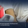 Ultrasonographic findings and the clinical symptoms of pelvic endometriosis