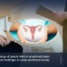 MRI Improves Deep Infiltrating Endometriosis Diagnosis