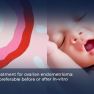 Having Endometriosis Surgery After IVF Better, Study Suggests